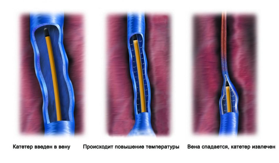 Радиочастотная облитерация вен РЧО - Личный сайт Малахова Ю.С, Сердечно-сосудистый хирург, флеболог