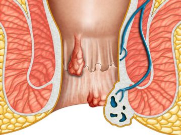 Почему люди затягивают с лечением геммороидальной болезни? 
