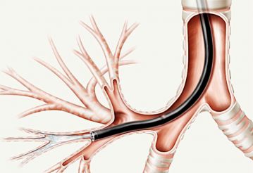 Подготовка к бронхоскопическим исследованиям