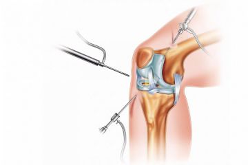 Артроскопия суставов