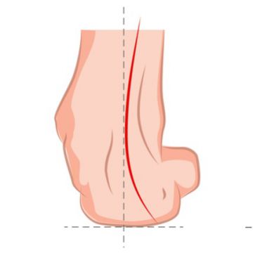 Оперативное лечение плоско-вальгусной деформации стопы